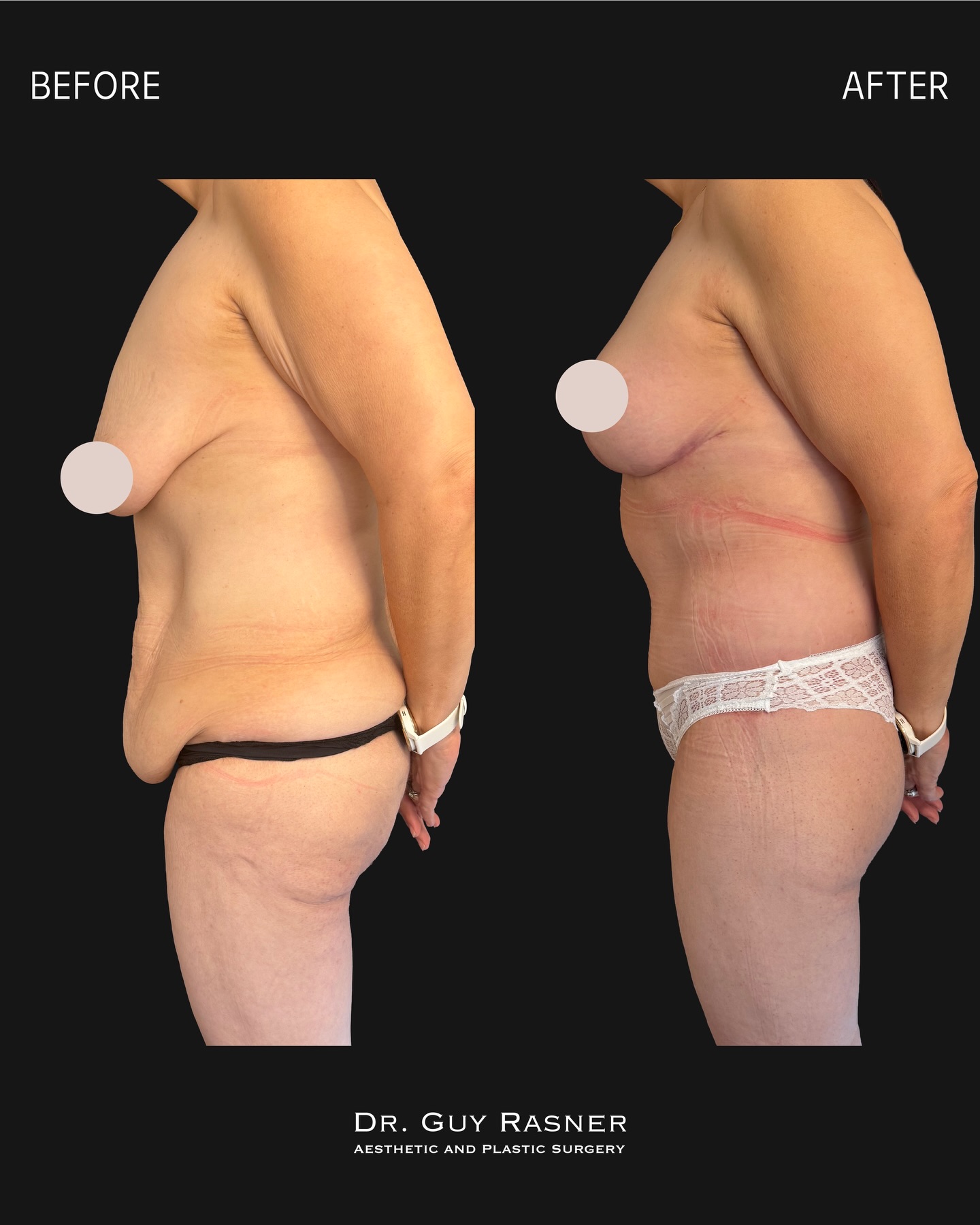 לפני ואחרי — מתיחת בטן · שאיבת שומן · הרמת חזה (תמונה 4 מתוך 6)