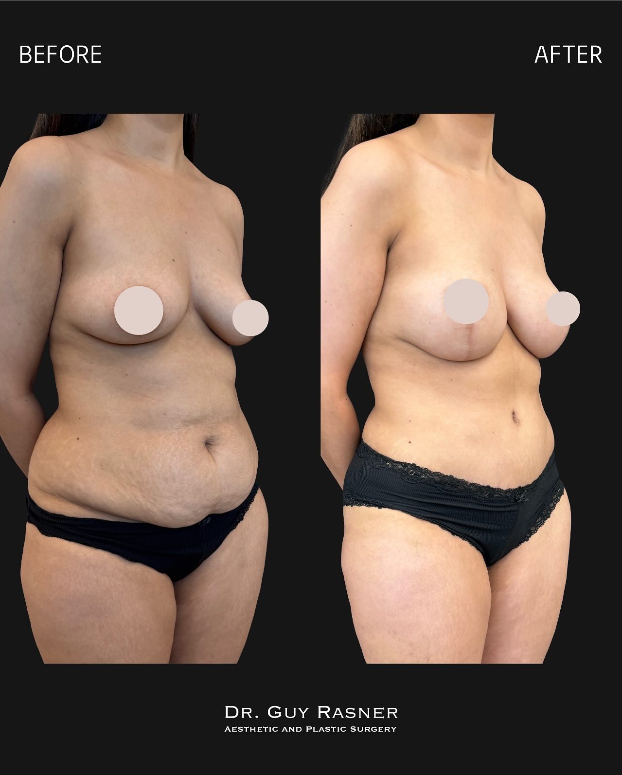 לפני ואחרי — מתיחת בטן · שאיבת שומן (תמונה 3 מתוך 5)